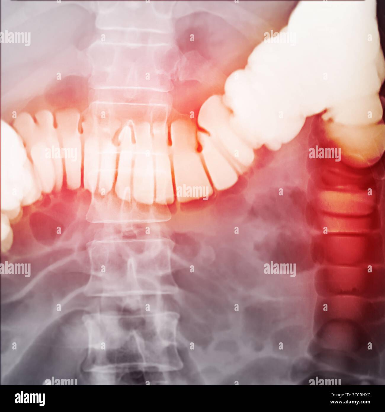 Une image diagnostique de lavement baryté montrant la présence de diverticulose dans le côlon transverse et ascendant, démontrant le diverticulaire typique f Banque D'Images