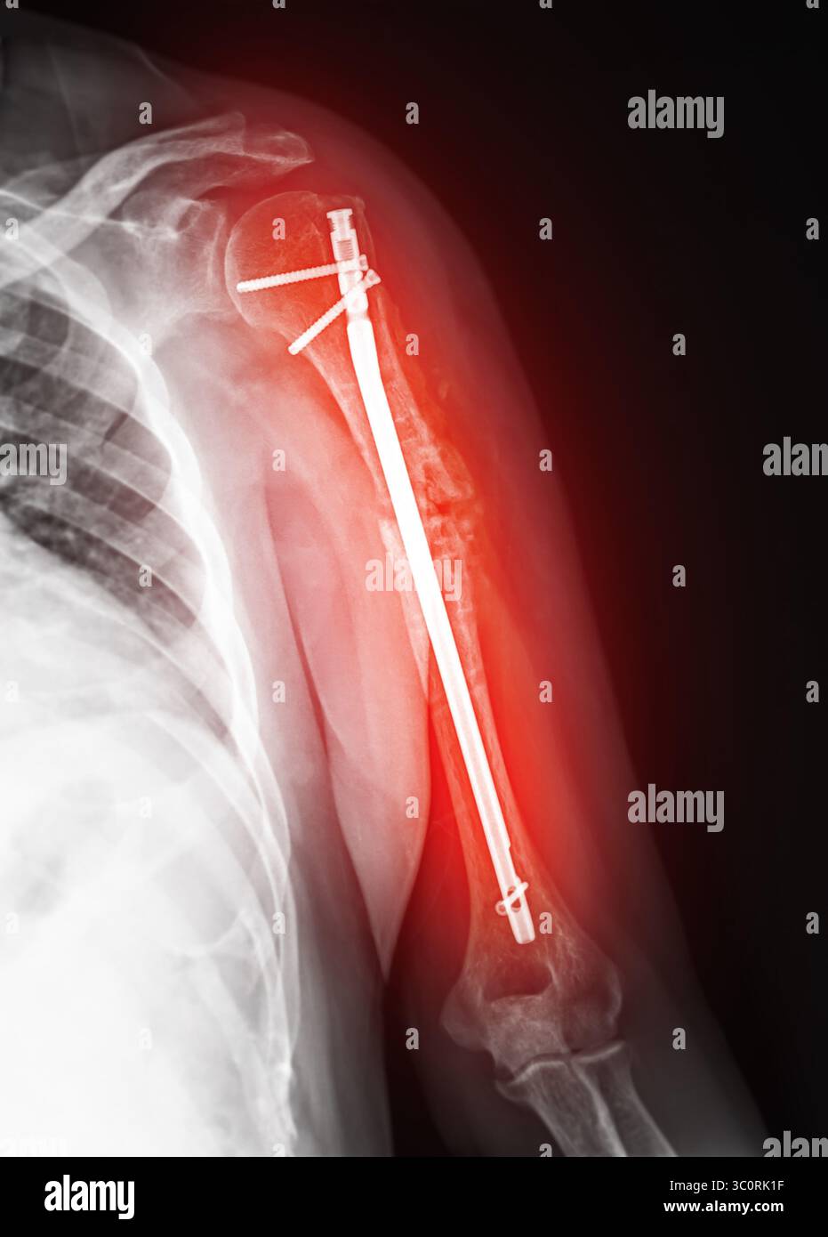 Radiographie révélant une fixation chirurgicale dans le bras suite à une fracture, avec des vis et une tige utilisées pour stabiliser les os pour une cicatrisation optimale. Banque D'Images Radiographie révélant une fixation chirurgicale dans le bras suite à une fracture, avec des vis et une tige utilisées pour stabiliser les os pour une cicatrisation optimale. Banque D'Images