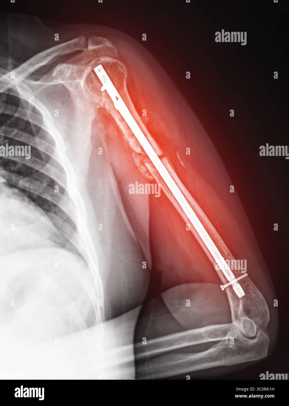 Radiographie révélant une fixation chirurgicale dans le bras suite à une fracture, avec des vis et une tige utilisées pour stabiliser les os pour une cicatrisation optimale. Banque D'Images Radiographie révélant une fixation chirurgicale dans le bras suite à une fracture, avec des vis et une tige utilisées pour stabiliser les os pour une cicatrisation optimale. Banque D'Images
