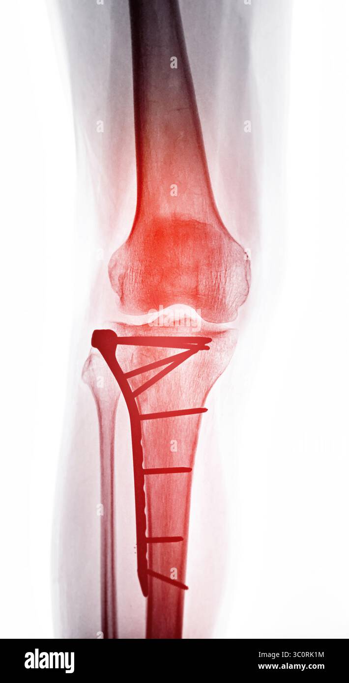 Radiographie diagnostique montrant une fracture postopératoire du genou, avec l'os maintenu ensemble par une plaque et des vis, illustrant l'intervention chirurgicale pour Banque D'Images Radiographie diagnostique montrant une fracture postopératoire du genou, avec l'os maintenu ensemble par une plaque et des vis, illustrant l'intervention chirurgicale pour Banque D'Images