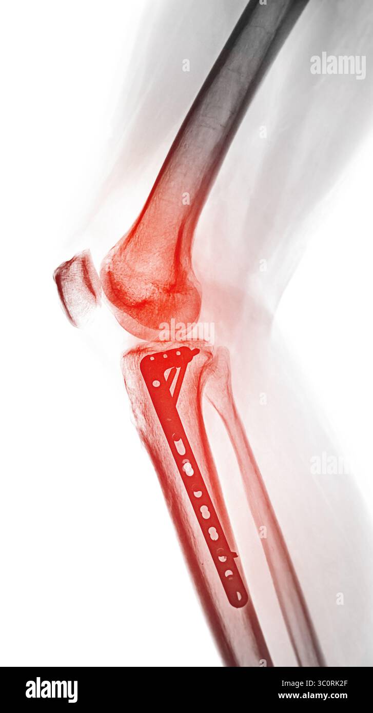 Radiographie diagnostique montrant une fracture postopératoire du genou, avec l'os maintenu ensemble par une plaque et des vis, illustrant l'intervention chirurgicale pour Banque D'Images Radiographie diagnostique montrant une fracture postopératoire du genou, avec l'os maintenu ensemble par une plaque et des vis, illustrant l'intervention chirurgicale pour Banque D'Images