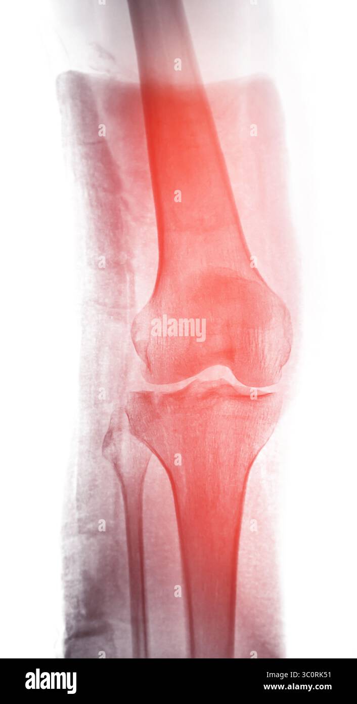 Image radiographique révélant une fracture du fémur dans le genou, avec une attelle appliquée pour maintenir l'alignement osseux pour une récupération correcte. Banque D'Images Image radiographique révélant une fracture du fémur dans le genou, avec une attelle appliquée pour maintenir l'alignement osseux pour une récupération correcte. Banque D'Images