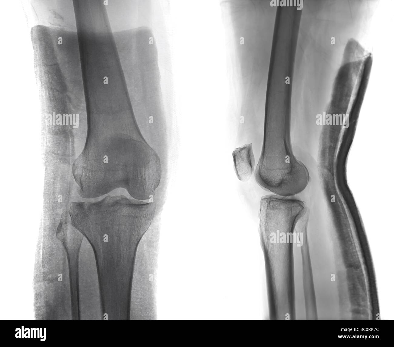 Image radiographique révélant une fracture du fémur dans le genou, avec une attelle appliquée pour maintenir l'alignement osseux pour une récupération correcte. Banque D'Images Image radiographique révélant une fracture du fémur dans le genou, avec une attelle appliquée pour maintenir l'alignement osseux pour une récupération correcte. Banque D'Images