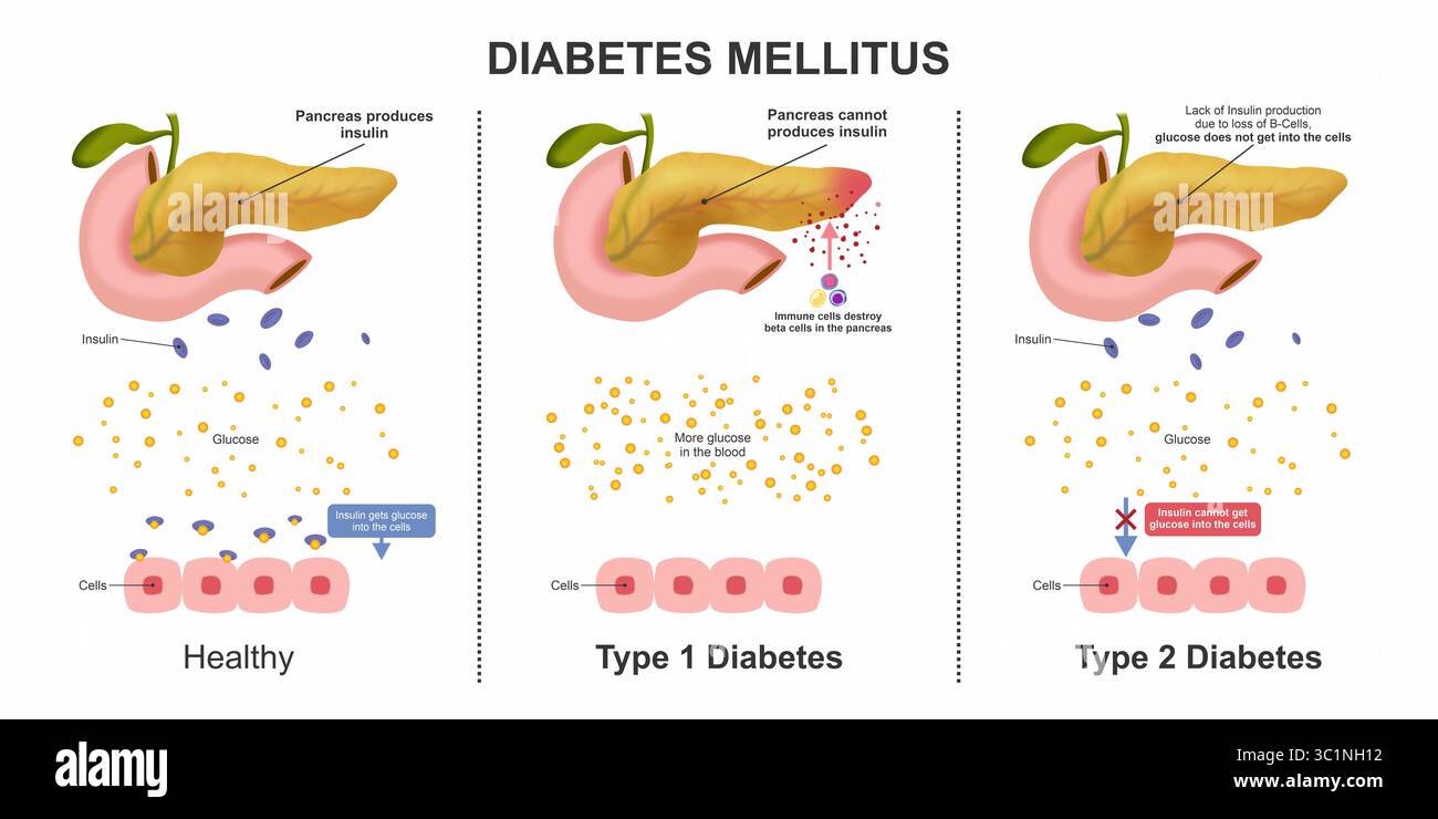 Diabète sucré types de diabète Banque D'Images