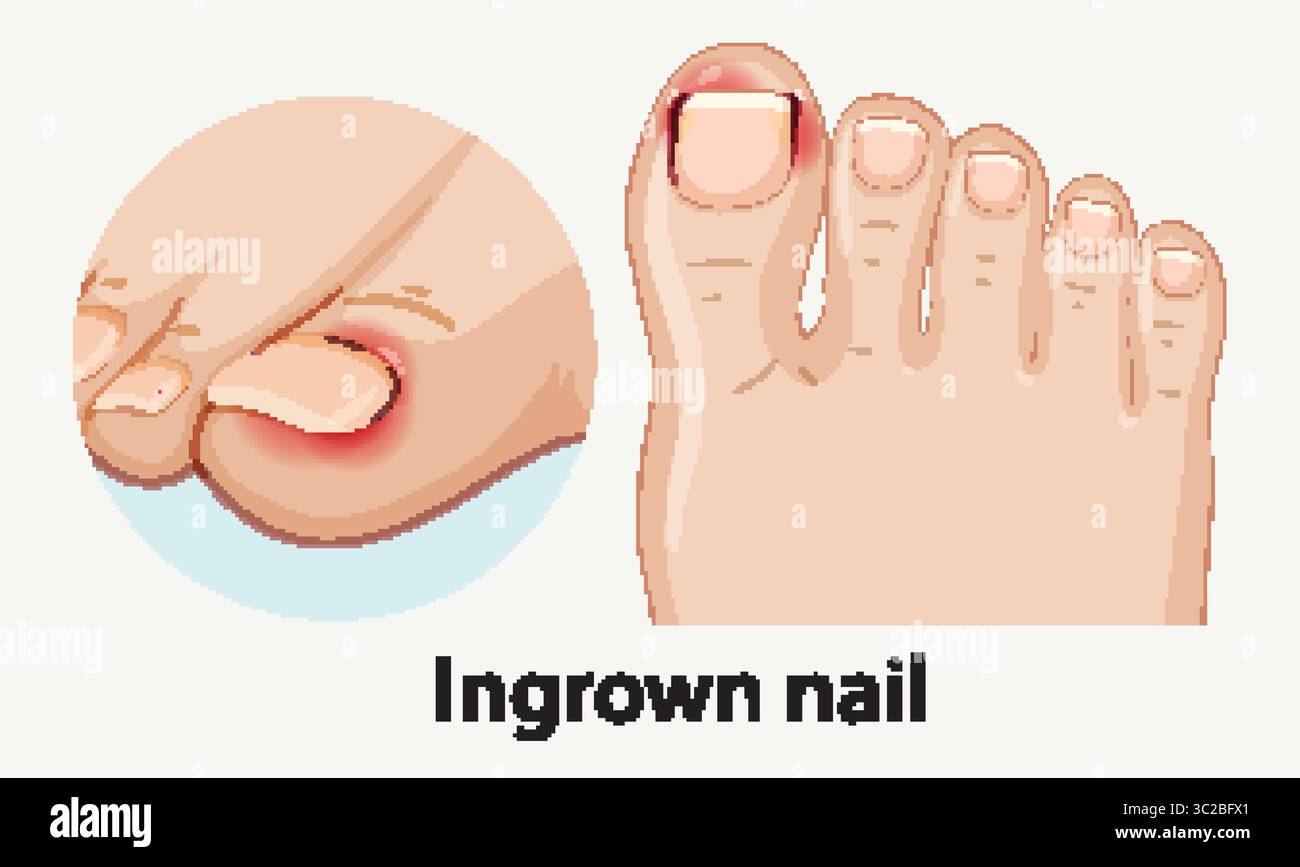 Illustration vectorielle médicale montrant un ongle incarné enflammé sur un pied, avec des détails en gros plan, un design plat et une précision anatomique claire Illustration de Vecteur