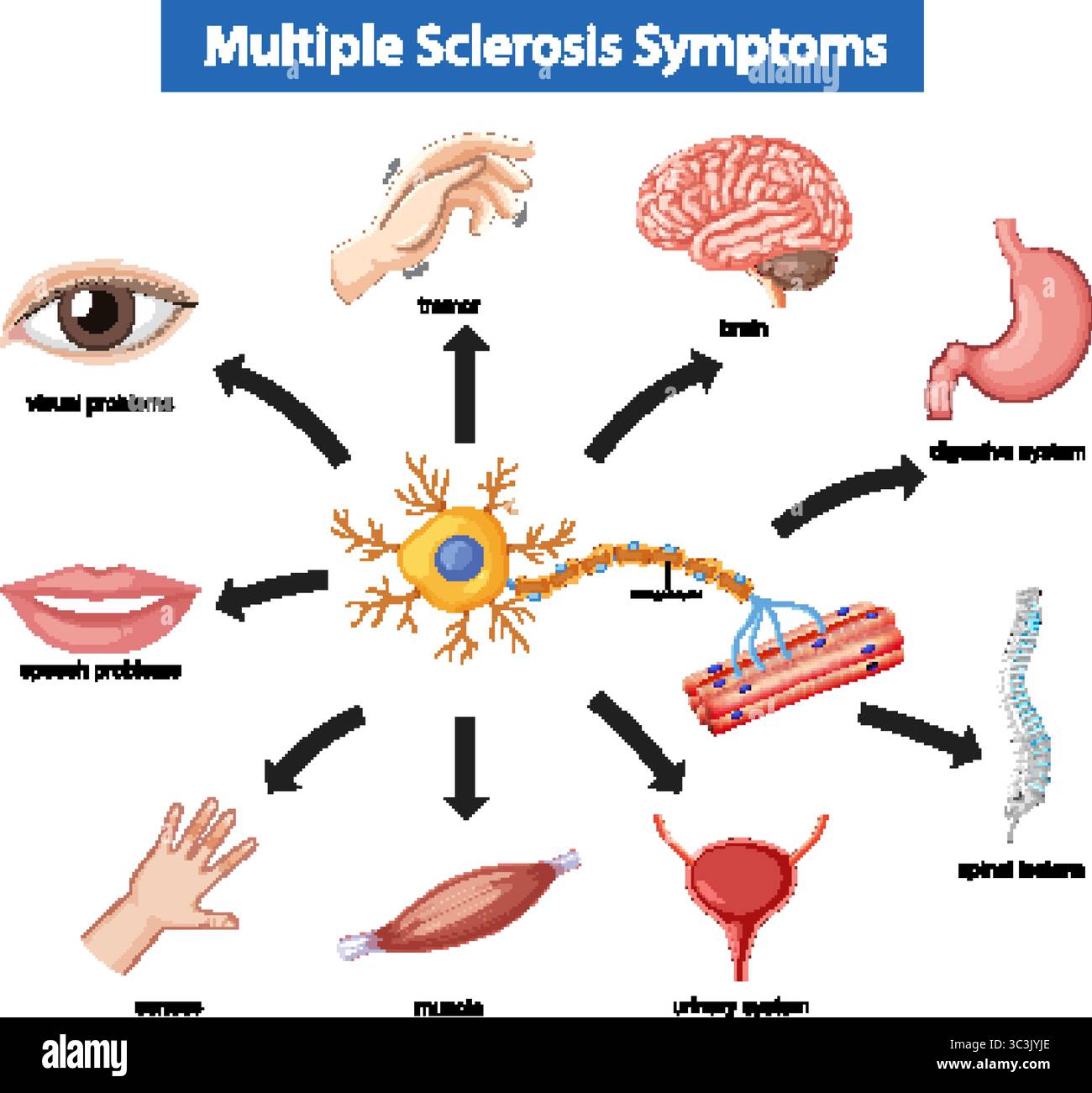 Illustration vectorielle colorée montre les symptômes de sclérose en plaques affectant le cerveau, les muscles, les sens, la parole, la vision, digestion, système urinaire et rachidien Illustration de Vecteur