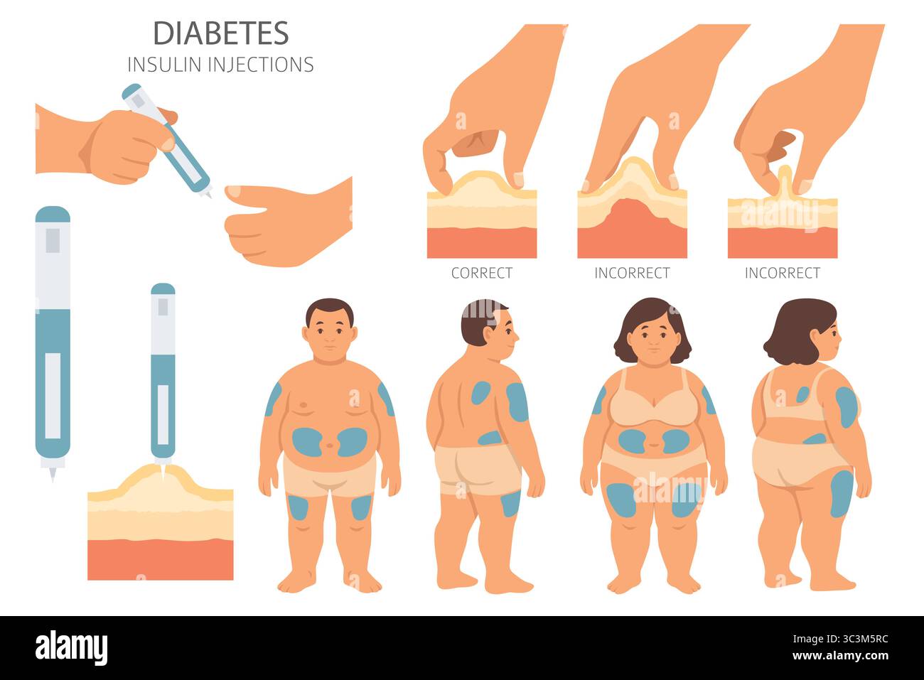 Diabète. Maladies endocriniennes. Conception infographique médicale. Illustration vectorielle Illustration de Vecteur