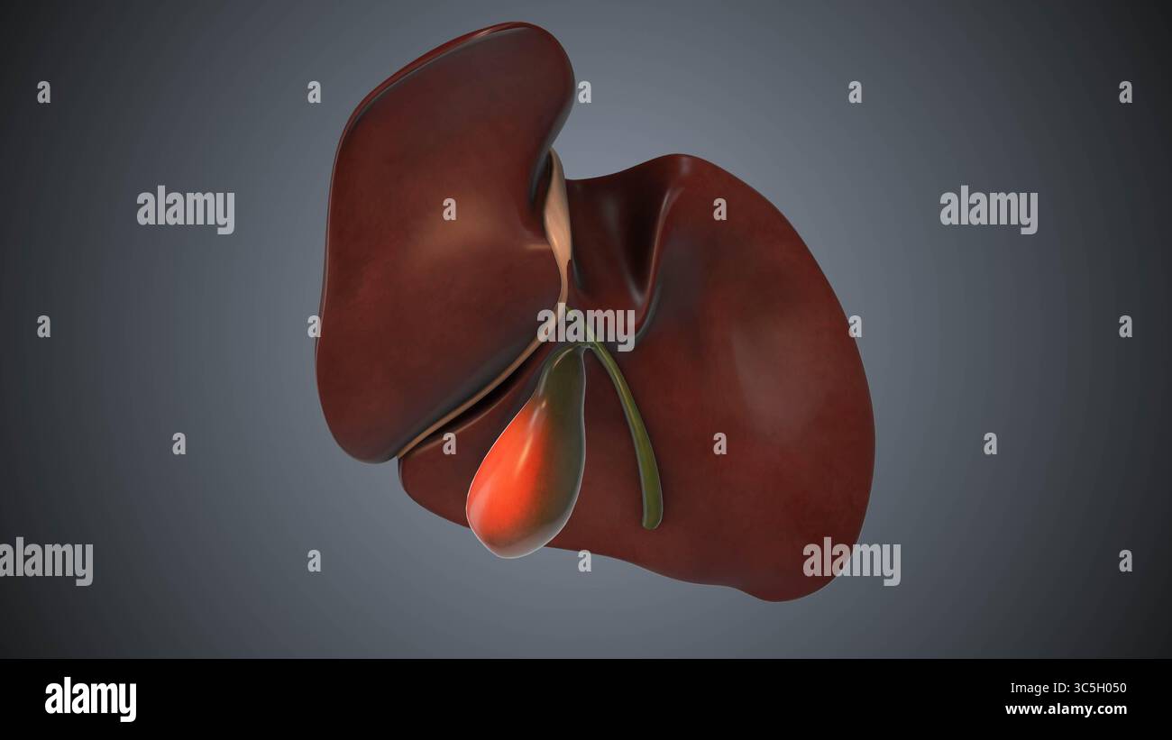 Cholécystectomie retrait vésicule biliaire animation médicale Banque D'Images Cholécystectomie retrait vésicule biliaire animation médicale Banque D'Images
