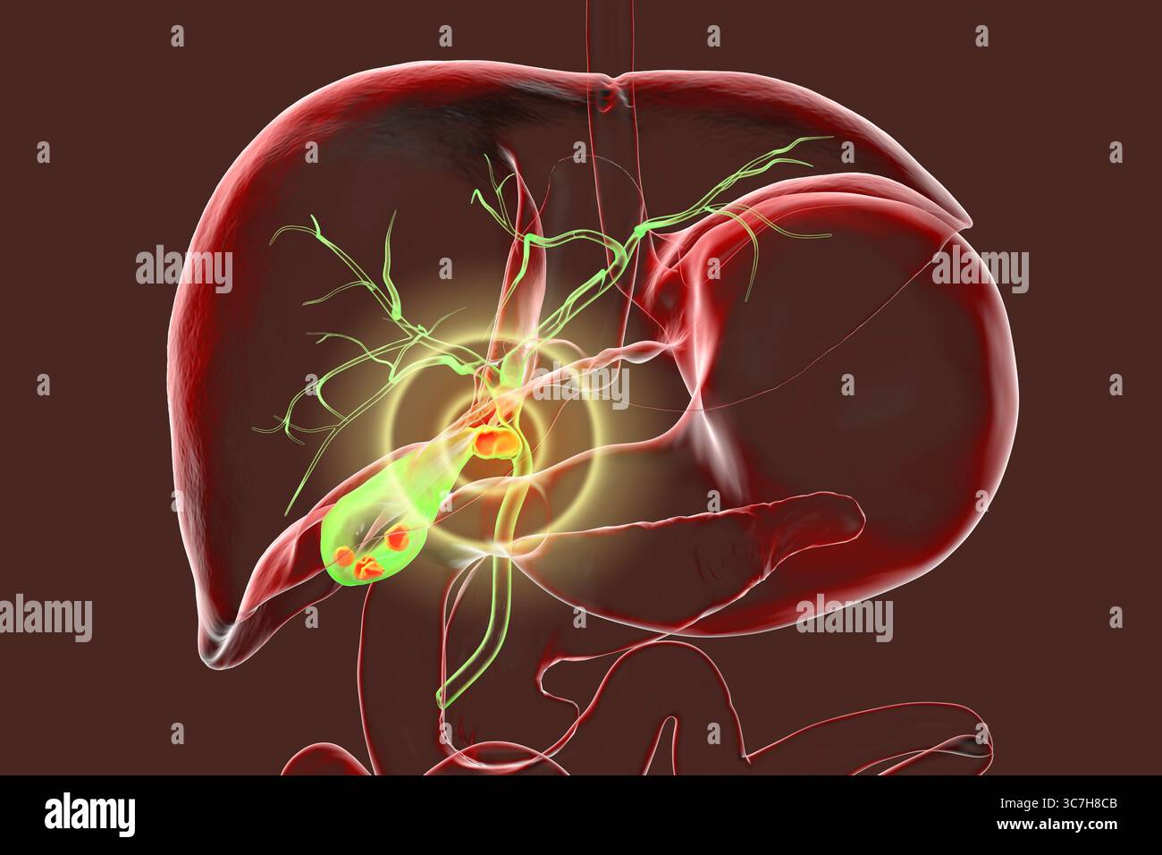 Illustration du syndrome de Mirizzi. Il s'agit d'une affection rare où un calcul biliaire inclus dans le canal cystique provoque un ictère obstructif et une inflammation. Banque D'Images