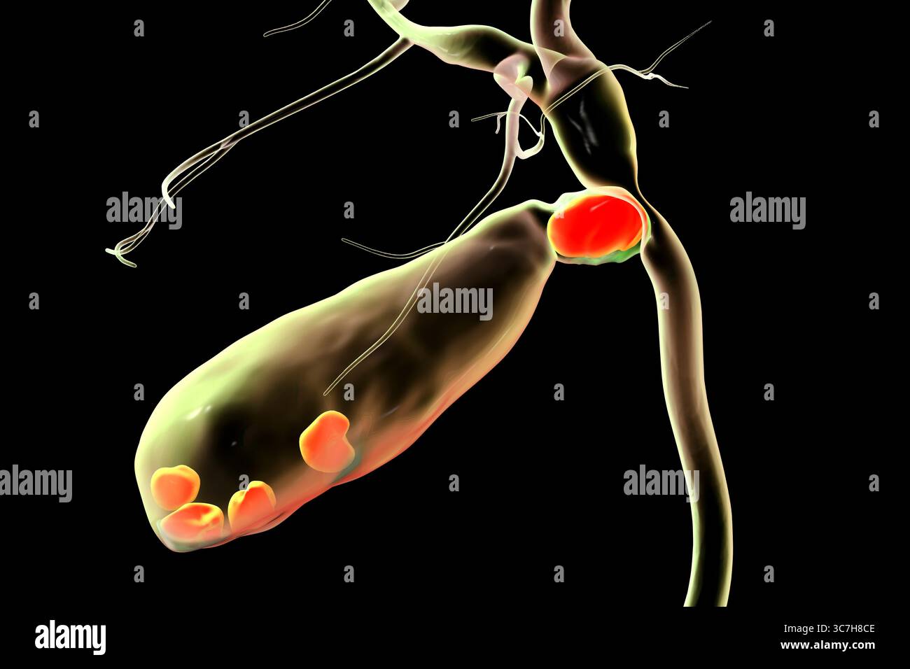 Illustration du syndrome de Mirizzi. Il s'agit d'une affection rare où un calcul biliaire inclus dans le canal cystique provoque un ictère obstructif et une inflammation. Banque D'Images