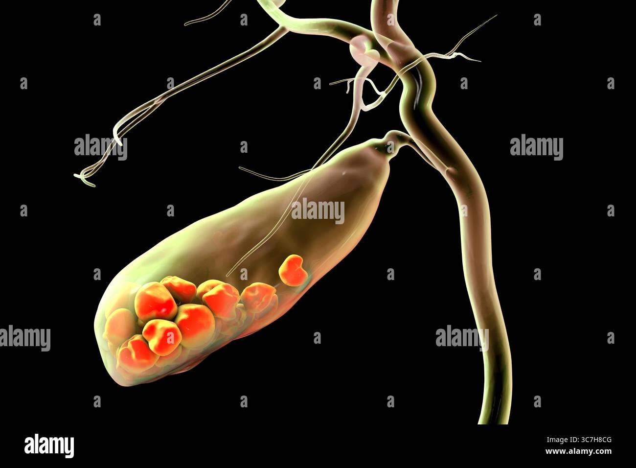 Illustration d'une vésicule biliaire avec des calculs, montrant la lithiase biliaire. Les calculs biliaires peuvent bloquer le flux biliaire et causer de la douleur, de l’inflammation ou une infection nécessitant un traitement médical ou chirurgical. Banque D'Images