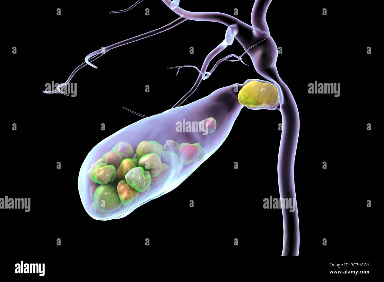 Illustration d'une vésicule biliaire avec des calculs, montrant la lithiase biliaire. Les calculs biliaires peuvent bloquer le flux biliaire et causer de la douleur, de l’inflammation ou une infection nécessitant un traitement médical ou chirurgical. Banque D'Images