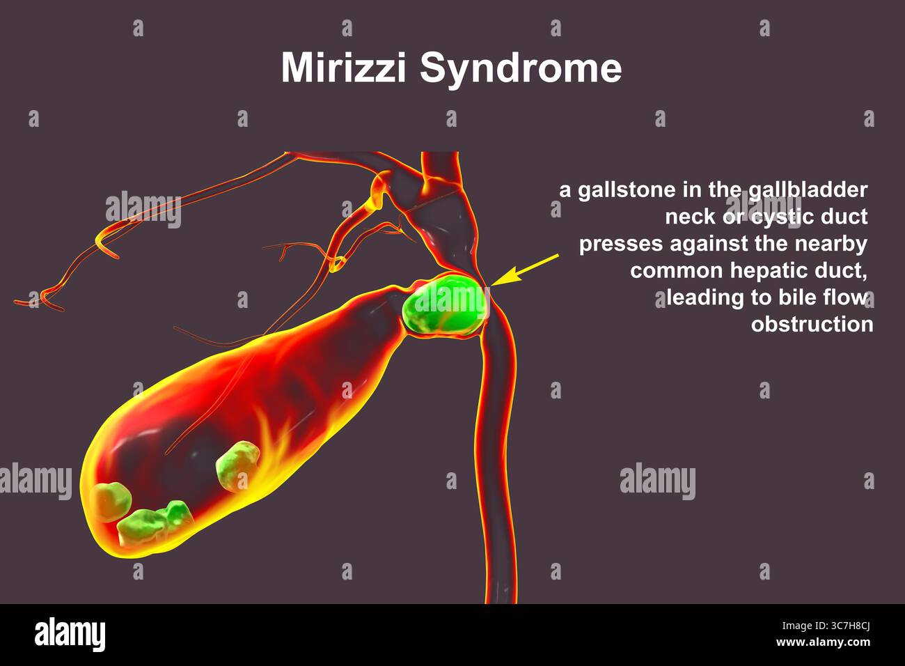 Illustration du syndrome de Mirizzi. Il s'agit d'une affection rare où un calcul biliaire inclus dans le canal cystique provoque un ictère obstructif et une inflammation. Banque D'Images