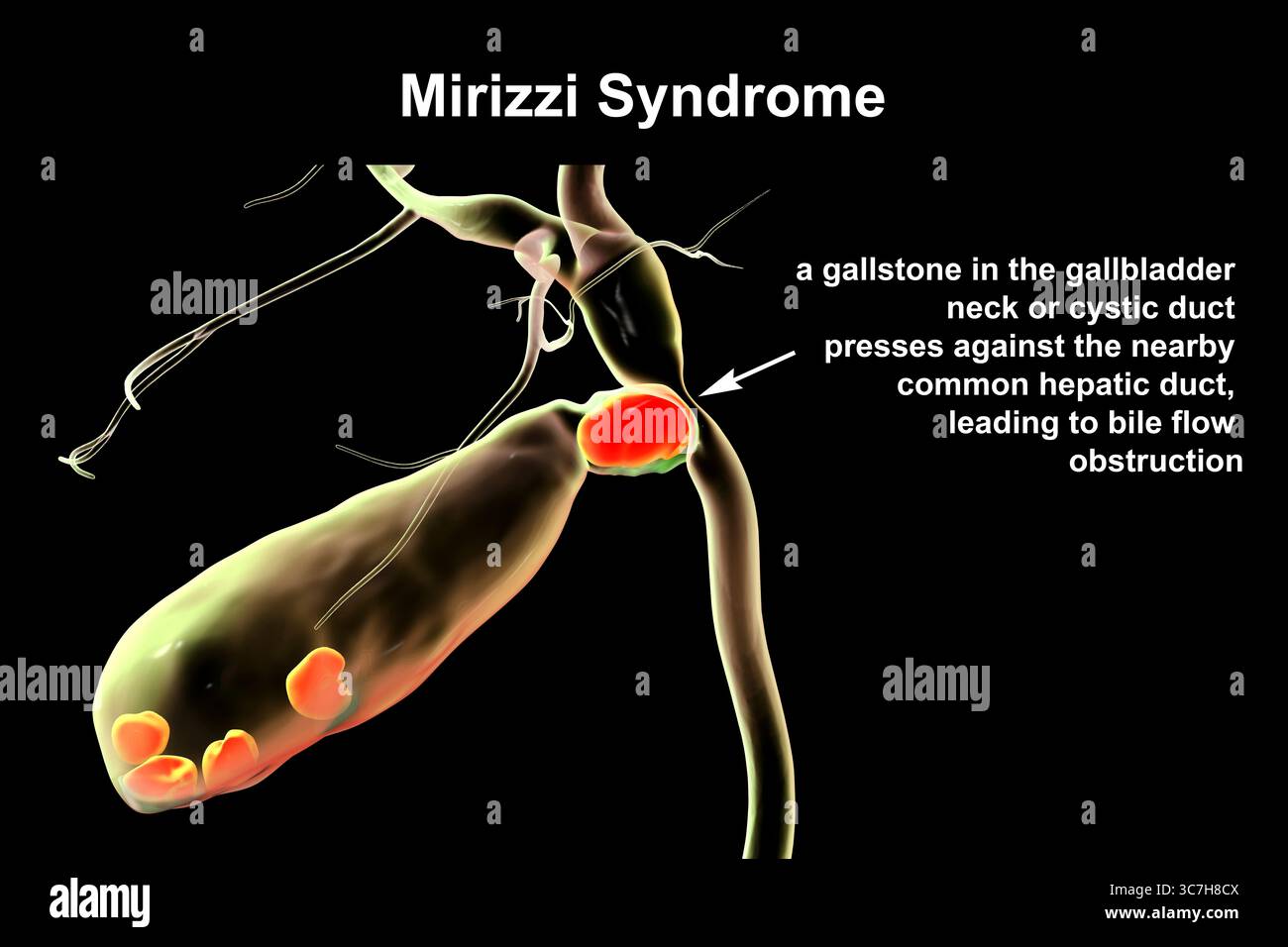 Illustration du syndrome de Mirizzi. Il s'agit d'une affection rare où un calcul biliaire inclus dans le canal cystique provoque un ictère obstructif et une inflammation. Banque D'Images