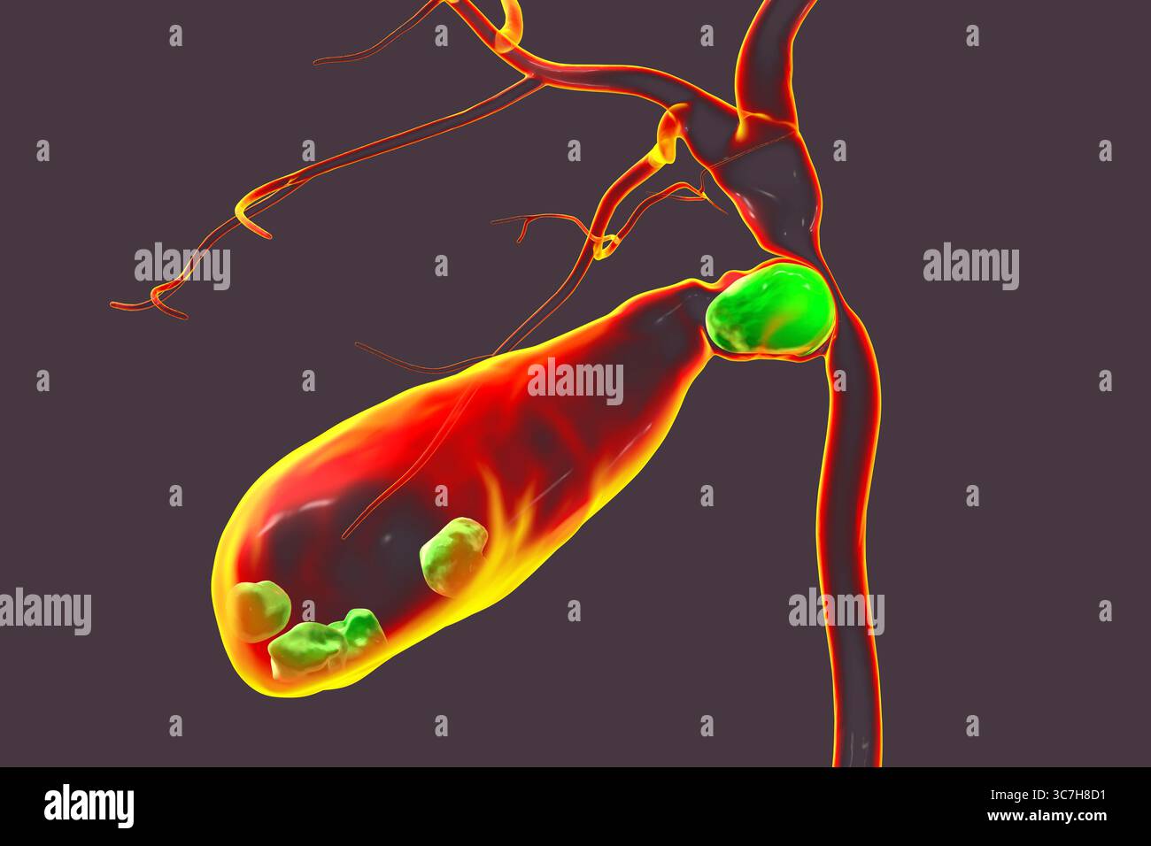Illustration du syndrome de Mirizzi. Il s'agit d'une affection rare où un calcul biliaire inclus dans le canal cystique provoque un ictère obstructif et une inflammation. Banque D'Images