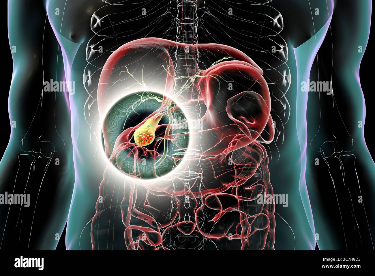 Illustration d'une vésicule biliaire avec des calculs, montrant la lithiase biliaire. Les calculs biliaires peuvent bloquer le flux biliaire et causer de la douleur, de l’inflammation ou une infection nécessitant un traitement médical ou chirurgical. Banque D'Images