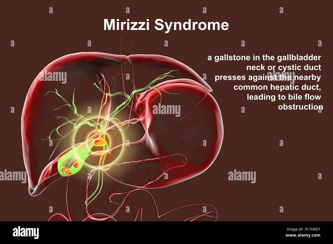 Illustration du syndrome de Mirizzi. Il s'agit d'une affection rare où un calcul biliaire inclus dans le canal cystique provoque un ictère obstructif et une inflammation. Banque D'Images
