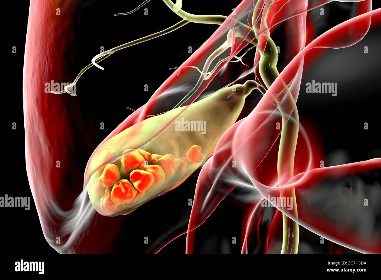 Illustration d'une vésicule biliaire avec des calculs, montrant la lithiase biliaire. Les calculs biliaires peuvent bloquer le flux biliaire et causer de la douleur, de l’inflammation ou une infection nécessitant un traitement médical ou chirurgical. Banque D'Images