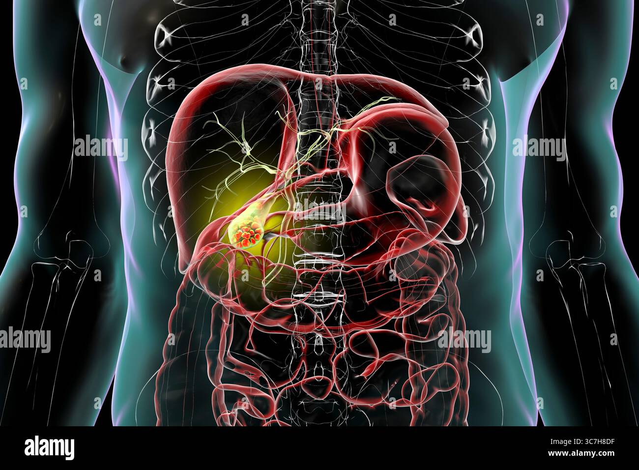 Illustration d'une vésicule biliaire avec des calculs, montrant la lithiase biliaire. Les calculs biliaires peuvent bloquer le flux biliaire et causer de la douleur, de l’inflammation ou une infection nécessitant un traitement médical ou chirurgical. Banque D'Images