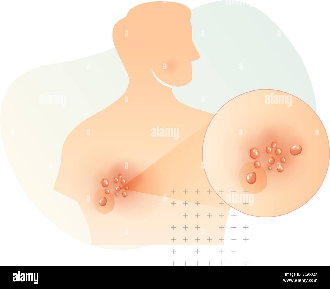 Un côté éruptions cutanées sur le dos - zoster herpès - bardeaux - illustration stock comme fichier EPS 10 Illustration de Vecteur Un côté éruptions cutanées sur le dos - zoster herpès - bardeaux - illustration stock comme fichier EPS 10 Illustration de Vecteur