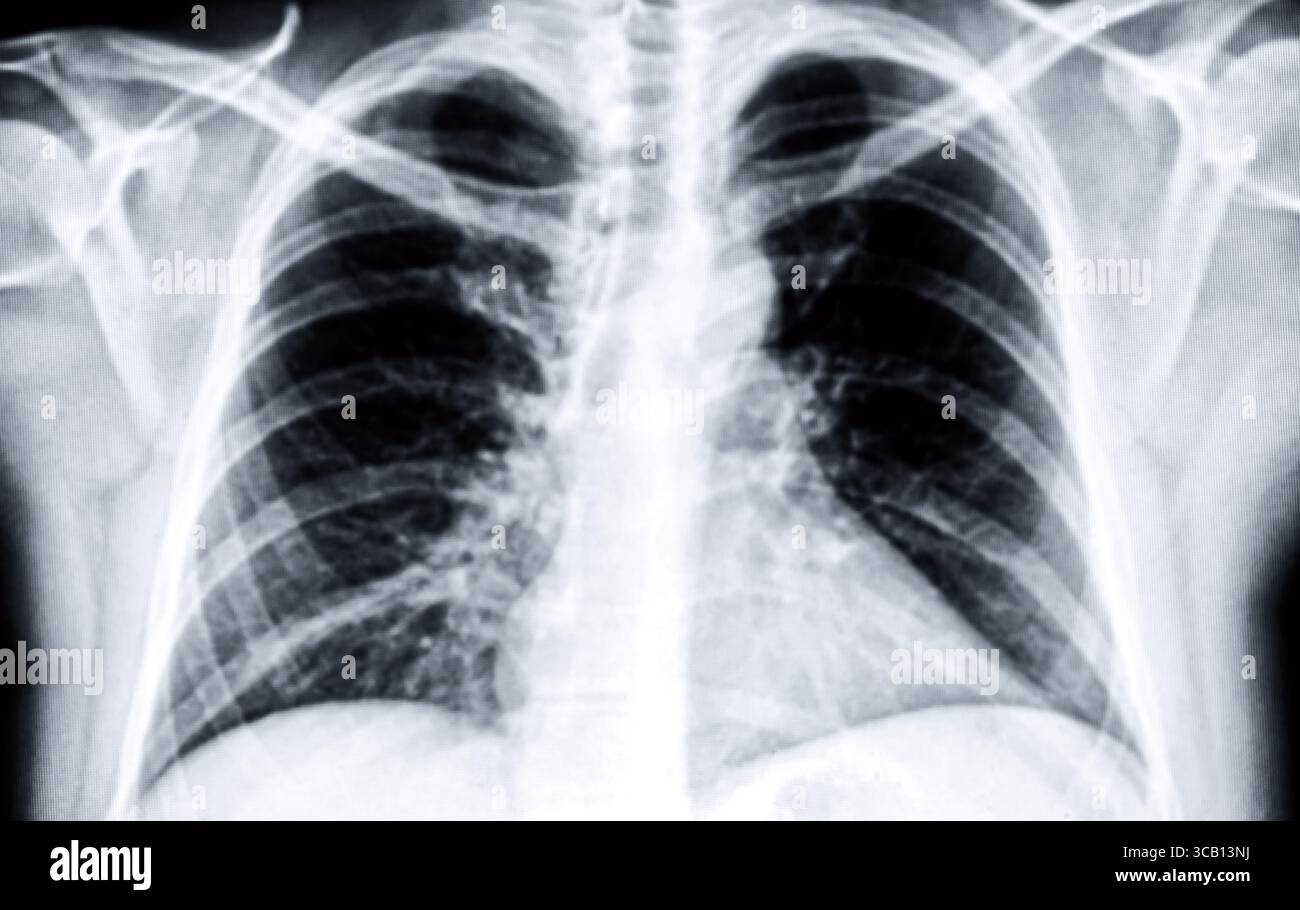 Détail d'une radiographie des poumons masculins. Noir et blanc. Banque D'Images