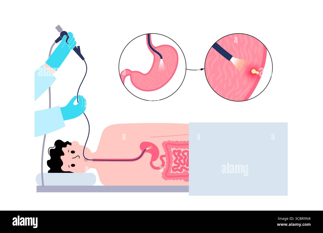 Illustration d'une gastroscopie, également connue sous le nom d'endoscopie supérieure. Il s'agit d'une procédure où un endoscope est inséré par la bouche pour examiner l'œsophage, l'estomac et le duodénum. Il aide à diagnostiquer et à traiter des affections comme les ulcères, les inflammations ou les tumeurs dans le tube digestif supérieur. Banque D'Images