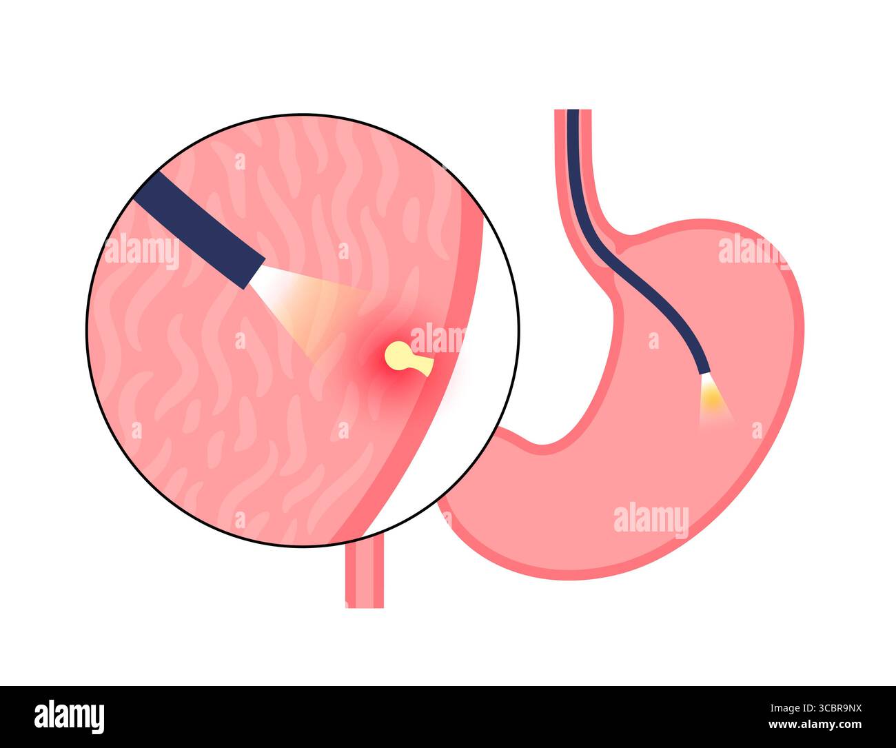 Illustration d'une gastroscopie, également connue sous le nom d'endoscopie supérieure. Il s'agit d'une procédure où un endoscope est inséré par la bouche pour examiner l'œsophage, l'estomac et le duodénum. Il aide à diagnostiquer et à traiter des affections comme les ulcères, les inflammations ou les tumeurs dans le tube digestif supérieur. Banque D'Images
