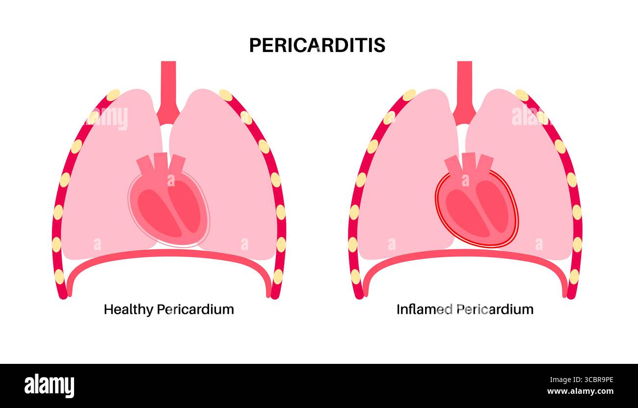 Illustration d'une péricardite cardiaque. Il s'agit d'une affection cardiaque caractérisée par une inflammation du péricarde, la structure semblable à un sac entourant le cœur. Une douleur thoracique aiguë est un symptôme courant, qui s’aggrave souvent avec des respirations profondes, couché ou toux. Elle peut être déclenchée par des infections virales ou bactériennes, des maladies auto-immunes ou des crises cardiaques. Banque D'Images Illustration d'une péricardite cardiaque. Il s'agit d'une affection cardiaque caractérisée par une inflammation du péricarde, la structure semblable à un sac entourant le cœur. Une douleur thoracique aiguë est un symptôme courant, qui s’aggrave souvent avec des respirations profondes, couché ou toux. Elle peut être déclenchée par des infections virales ou bactériennes, des maladies auto-immunes ou des crises cardiaques. Banque D'Images