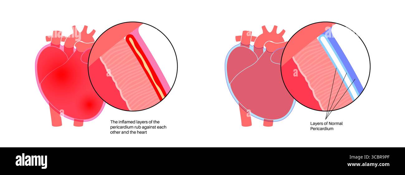 Illustration d'une péricardite cardiaque. Il s'agit d'une affection cardiaque caractérisée par une inflammation du péricarde, la structure semblable à un sac entourant le cœur. Une douleur thoracique aiguë est un symptôme courant, qui s’aggrave souvent avec des respirations profondes, couché ou toux. Elle peut être déclenchée par des infections virales ou bactériennes, des maladies auto-immunes ou des crises cardiaques. Banque D'Images Illustration d'une péricardite cardiaque. Il s'agit d'une affection cardiaque caractérisée par une inflammation du péricarde, la structure semblable à un sac entourant le cœur. Une douleur thoracique aiguë est un symptôme courant, qui s’aggrave souvent avec des respirations profondes, couché ou toux. Elle peut être déclenchée par des infections virales ou bactériennes, des maladies auto-immunes ou des crises cardiaques. Banque D'Images