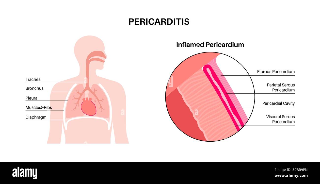Illustration d'une péricardite cardiaque. Il s'agit d'une affection cardiaque caractérisée par une inflammation du péricarde, la structure semblable à un sac entourant le cœur. Une douleur thoracique aiguë est un symptôme courant, qui s’aggrave souvent avec des respirations profondes, couché ou toux. Elle peut être déclenchée par des infections virales ou bactériennes, des maladies auto-immunes ou des crises cardiaques. Banque D'Images Illustration d'une péricardite cardiaque. Il s'agit d'une affection cardiaque caractérisée par une inflammation du péricarde, la structure semblable à un sac entourant le cœur. Une douleur thoracique aiguë est un symptôme courant, qui s’aggrave souvent avec des respirations profondes, couché ou toux. Elle peut être déclenchée par des infections virales ou bactériennes, des maladies auto-immunes ou des crises cardiaques. Banque D'Images