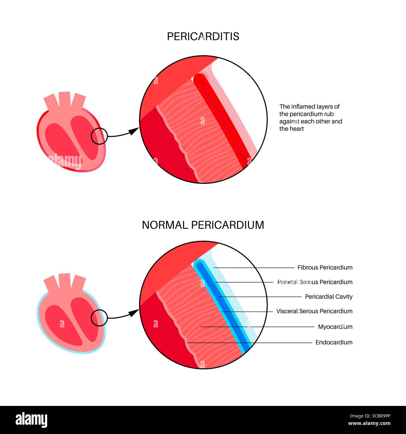 Illustration d'une péricardite cardiaque. Il s'agit d'une affection cardiaque caractérisée par une inflammation du péricarde, la structure semblable à un sac entourant le cœur. Une douleur thoracique aiguë est un symptôme courant, qui s’aggrave souvent avec des respirations profondes, couché ou toux. Elle peut être déclenchée par des infections virales ou bactériennes, des maladies auto-immunes ou des crises cardiaques. Banque D'Images Illustration d'une péricardite cardiaque. Il s'agit d'une affection cardiaque caractérisée par une inflammation du péricarde, la structure semblable à un sac entourant le cœur. Une douleur thoracique aiguë est un symptôme courant, qui s’aggrave souvent avec des respirations profondes, couché ou toux. Elle peut être déclenchée par des infections virales ou bactériennes, des maladies auto-immunes ou des crises cardiaques. Banque D'Images