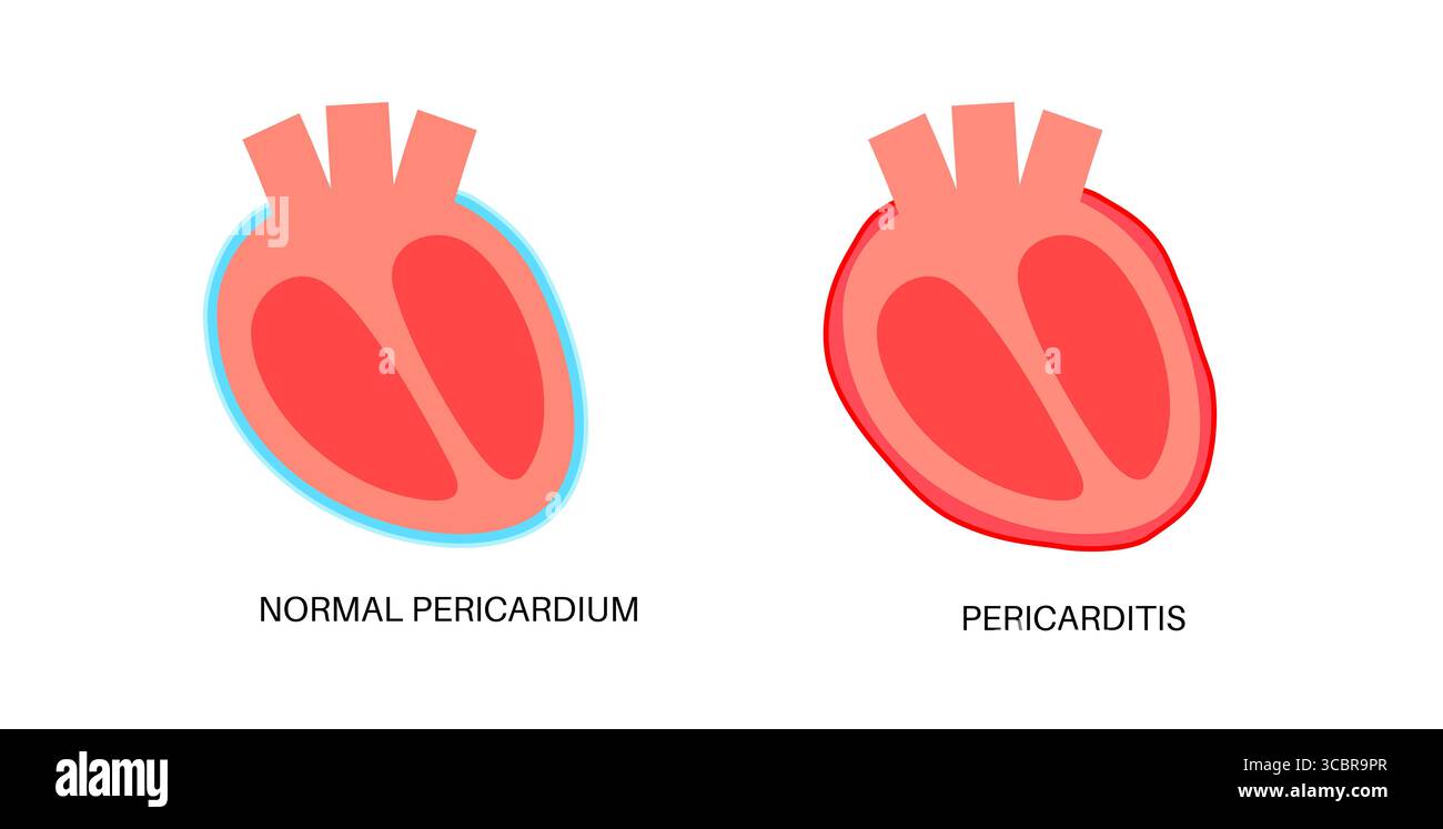 Illustration d'une péricardite cardiaque. Il s'agit d'une affection cardiaque caractérisée par une inflammation du péricarde, la structure semblable à un sac entourant le cœur. Une douleur thoracique aiguë est un symptôme courant, qui s’aggrave souvent avec des respirations profondes, couché ou toux. Elle peut être déclenchée par des infections virales ou bactériennes, des maladies auto-immunes ou des crises cardiaques. Banque D'Images Illustration d'une péricardite cardiaque. Il s'agit d'une affection cardiaque caractérisée par une inflammation du péricarde, la structure semblable à un sac entourant le cœur. Une douleur thoracique aiguë est un symptôme courant, qui s’aggrave souvent avec des respirations profondes, couché ou toux. Elle peut être déclenchée par des infections virales ou bactériennes, des maladies auto-immunes ou des crises cardiaques. Banque D'Images