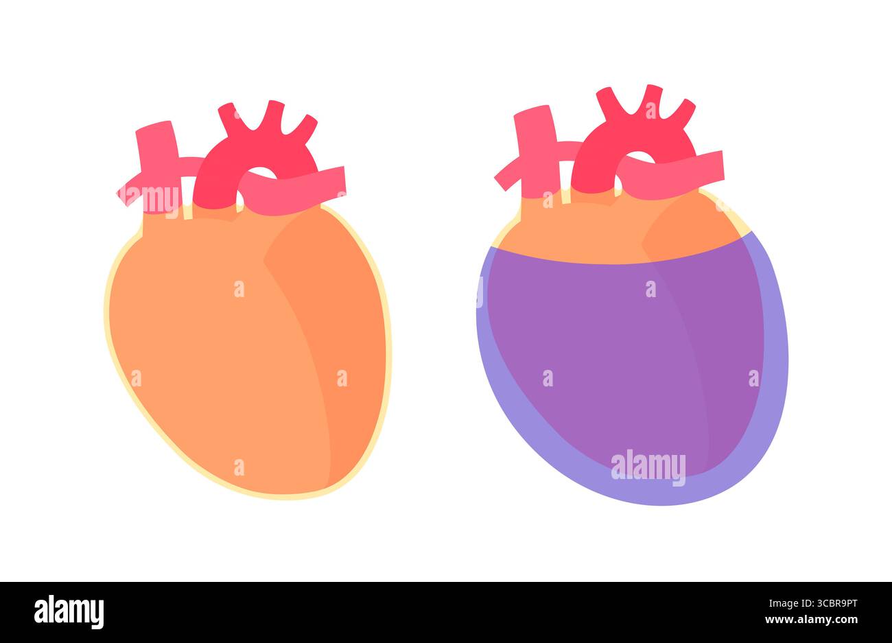 Illustration d'épanchement péricardique du coeur. Il s'agit de l'accumulation d'excès de liquide dans l'espace péricardique, le sac entourant le cœur. Cette accumulation de liquide peut exercer une pression sur le cœur, ce qui peut nuire à sa capacité à pomper efficacement le sang. Banque D'Images Illustration d'épanchement péricardique du coeur. Il s'agit de l'accumulation d'excès de liquide dans l'espace péricardique, le sac entourant le cœur. Cette accumulation de liquide peut exercer une pression sur le cœur, ce qui peut nuire à sa capacité à pomper efficacement le sang. Banque D'Images