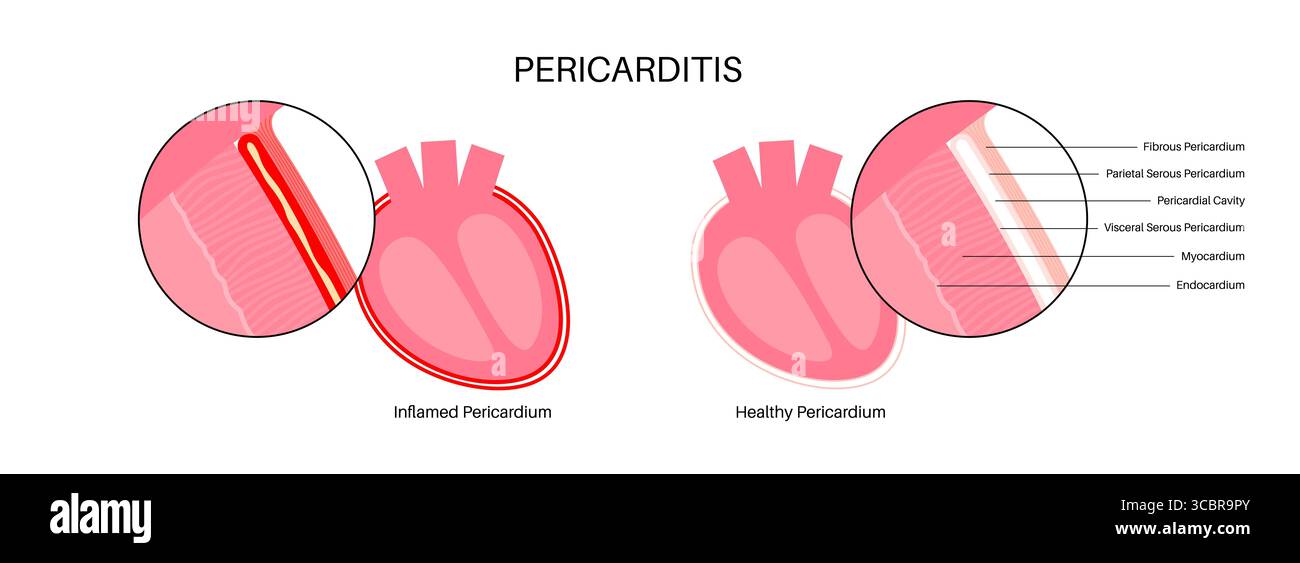 Illustration d'une péricardite cardiaque. Il s'agit d'une affection cardiaque caractérisée par une inflammation du péricarde, la structure semblable à un sac entourant le cœur. Une douleur thoracique aiguë est un symptôme courant, qui s’aggrave souvent avec des respirations profondes, couché ou toux. Elle peut être déclenchée par des infections virales ou bactériennes, des maladies auto-immunes ou des crises cardiaques. Banque D'Images Illustration d'une péricardite cardiaque. Il s'agit d'une affection cardiaque caractérisée par une inflammation du péricarde, la structure semblable à un sac entourant le cœur. Une douleur thoracique aiguë est un symptôme courant, qui s’aggrave souvent avec des respirations profondes, couché ou toux. Elle peut être déclenchée par des infections virales ou bactériennes, des maladies auto-immunes ou des crises cardiaques. Banque D'Images