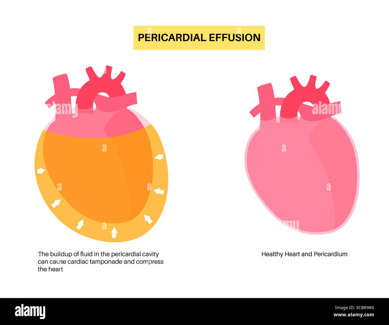 Illustration d'épanchement péricardique du coeur. Il s'agit de l'accumulation d'excès de liquide dans l'espace péricardique, le sac entourant le cœur. Cette accumulation de liquide peut exercer une pression sur le cœur, ce qui peut nuire à sa capacité à pomper efficacement le sang. Banque D'Images Illustration d'épanchement péricardique du coeur. Il s'agit de l'accumulation d'excès de liquide dans l'espace péricardique, le sac entourant le cœur. Cette accumulation de liquide peut exercer une pression sur le cœur, ce qui peut nuire à sa capacité à pomper efficacement le sang. Banque D'Images