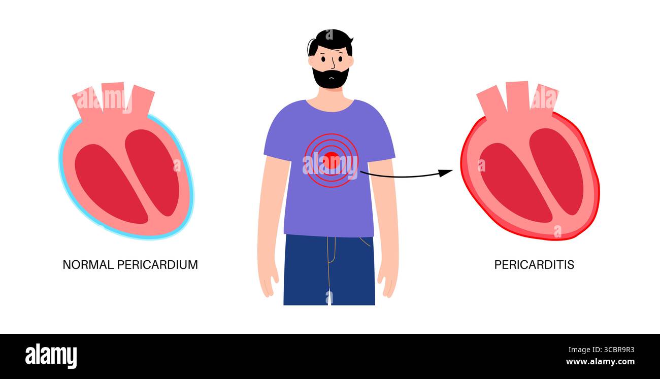 Illustration d'une péricardite cardiaque. Il s'agit d'une affection cardiaque caractérisée par une inflammation du péricarde, la structure semblable à un sac entourant le cœur. Une douleur thoracique aiguë est un symptôme courant, qui s’aggrave souvent avec des respirations profondes, couché ou toux. Elle peut être déclenchée par des infections virales ou bactériennes, des maladies auto-immunes ou des crises cardiaques. Banque D'Images Illustration d'une péricardite cardiaque. Il s'agit d'une affection cardiaque caractérisée par une inflammation du péricarde, la structure semblable à un sac entourant le cœur. Une douleur thoracique aiguë est un symptôme courant, qui s’aggrave souvent avec des respirations profondes, couché ou toux. Elle peut être déclenchée par des infections virales ou bactériennes, des maladies auto-immunes ou des crises cardiaques. Banque D'Images