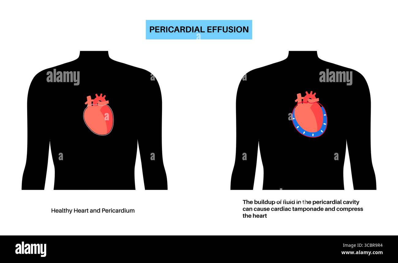 Illustration d'épanchement péricardique du coeur. Il s'agit de l'accumulation d'excès de liquide dans l'espace péricardique, le sac entourant le cœur. Cette accumulation de liquide peut exercer une pression sur le cœur, ce qui peut nuire à sa capacité à pomper efficacement le sang. Banque D'Images Illustration d'épanchement péricardique du coeur. Il s'agit de l'accumulation d'excès de liquide dans l'espace péricardique, le sac entourant le cœur. Cette accumulation de liquide peut exercer une pression sur le cœur, ce qui peut nuire à sa capacité à pomper efficacement le sang. Banque D'Images