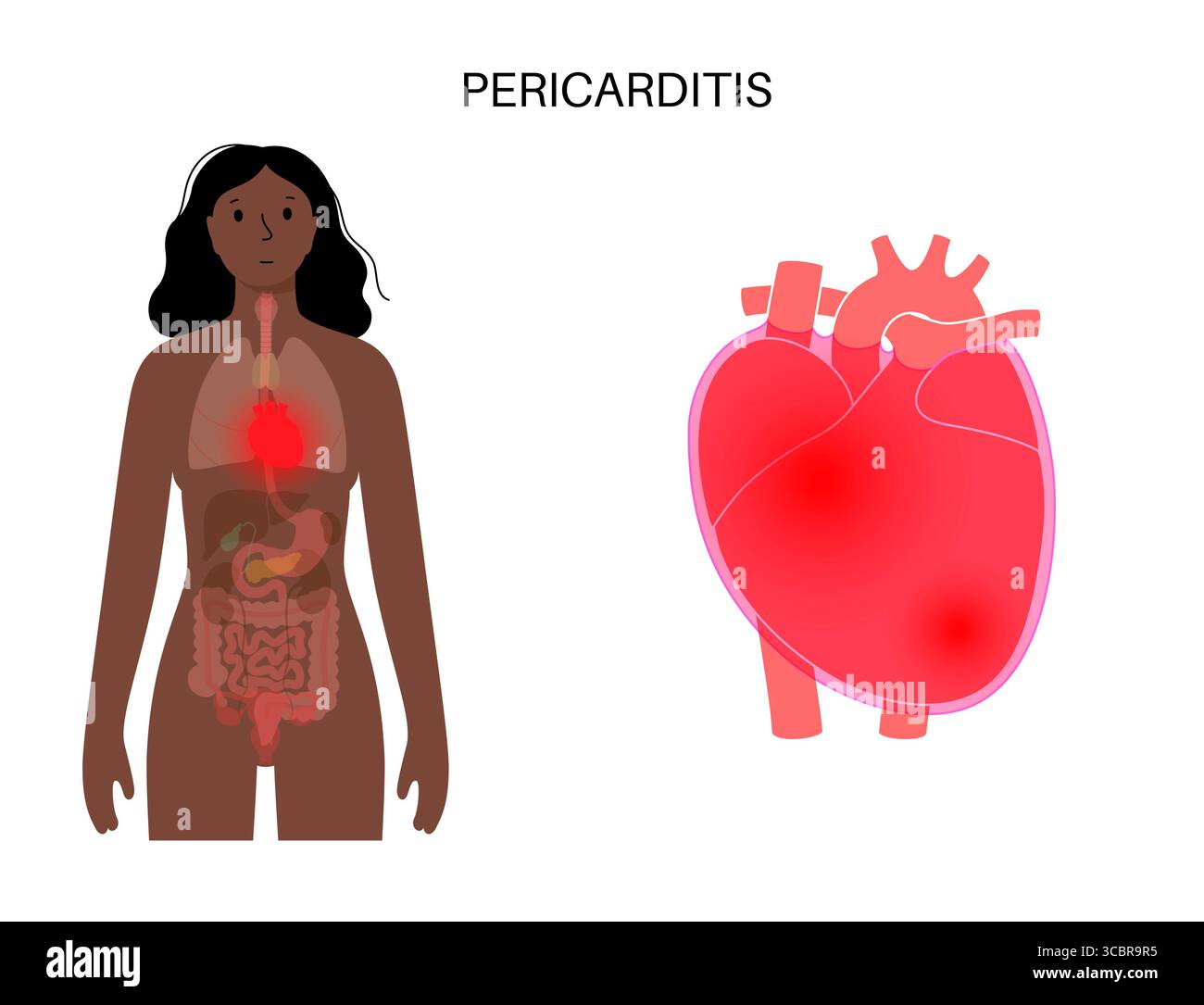 Illustration d'une péricardite cardiaque. Il s'agit d'une affection cardiaque caractérisée par une inflammation du péricarde, la structure semblable à un sac entourant le cœur. Une douleur thoracique aiguë est un symptôme courant, qui s’aggrave souvent avec des respirations profondes, couché ou toux. Elle peut être déclenchée par des infections virales ou bactériennes, des maladies auto-immunes ou des crises cardiaques. Banque D'Images Illustration d'une péricardite cardiaque. Il s'agit d'une affection cardiaque caractérisée par une inflammation du péricarde, la structure semblable à un sac entourant le cœur. Une douleur thoracique aiguë est un symptôme courant, qui s’aggrave souvent avec des respirations profondes, couché ou toux. Elle peut être déclenchée par des infections virales ou bactériennes, des maladies auto-immunes ou des crises cardiaques. Banque D'Images