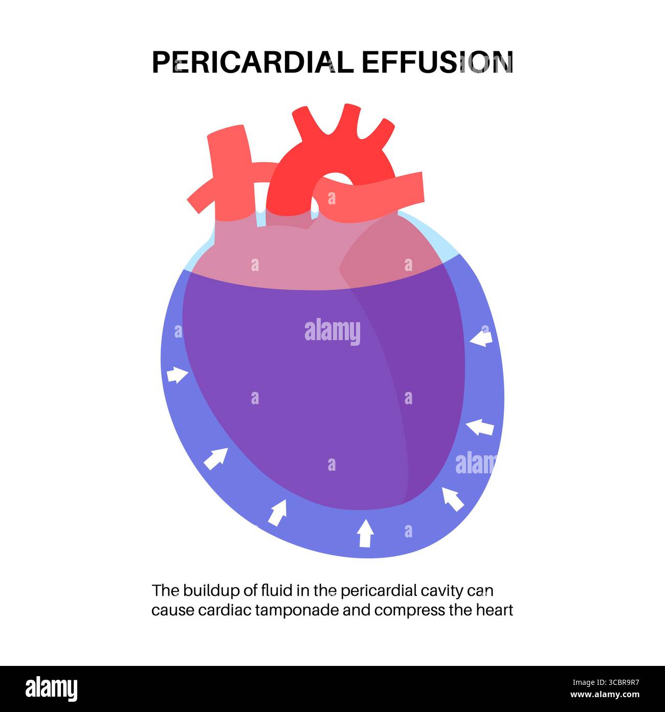 Illustration d'épanchement péricardique du coeur. Il s'agit de l'accumulation d'excès de liquide dans l'espace péricardique, le sac entourant le cœur. Cette accumulation de liquide peut exercer une pression sur le cœur, ce qui peut nuire à sa capacité à pomper efficacement le sang. Banque D'Images Illustration d'épanchement péricardique du coeur. Il s'agit de l'accumulation d'excès de liquide dans l'espace péricardique, le sac entourant le cœur. Cette accumulation de liquide peut exercer une pression sur le cœur, ce qui peut nuire à sa capacité à pomper efficacement le sang. Banque D'Images