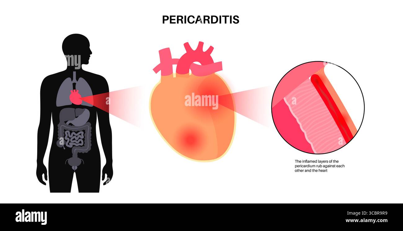 Illustration d'une péricardite cardiaque. Il s'agit d'une affection cardiaque caractérisée par une inflammation du péricarde, la structure semblable à un sac entourant le cœur. Une douleur thoracique aiguë est un symptôme courant, qui s’aggrave souvent avec des respirations profondes, couché ou toux. Elle peut être déclenchée par des infections virales ou bactériennes, des maladies auto-immunes ou des crises cardiaques. Banque D'Images Illustration d'une péricardite cardiaque. Il s'agit d'une affection cardiaque caractérisée par une inflammation du péricarde, la structure semblable à un sac entourant le cœur. Une douleur thoracique aiguë est un symptôme courant, qui s’aggrave souvent avec des respirations profondes, couché ou toux. Elle peut être déclenchée par des infections virales ou bactériennes, des maladies auto-immunes ou des crises cardiaques. Banque D'Images