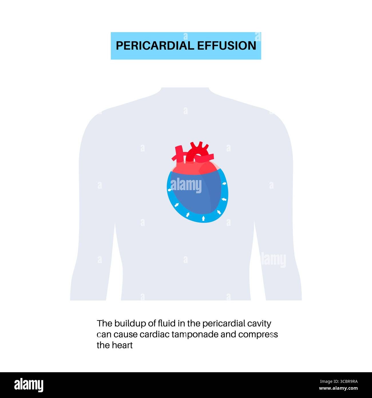 Illustration d'épanchement péricardique du coeur. Il s'agit de l'accumulation d'excès de liquide dans l'espace péricardique, le sac entourant le cœur. Cette accumulation de liquide peut exercer une pression sur le cœur, ce qui peut nuire à sa capacité à pomper efficacement le sang. Banque D'Images Illustration d'épanchement péricardique du coeur. Il s'agit de l'accumulation d'excès de liquide dans l'espace péricardique, le sac entourant le cœur. Cette accumulation de liquide peut exercer une pression sur le cœur, ce qui peut nuire à sa capacité à pomper efficacement le sang. Banque D'Images