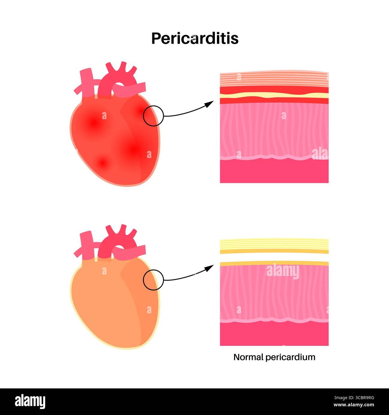 Illustration d'une péricardite cardiaque. Il s'agit d'une affection cardiaque caractérisée par une inflammation du péricarde, la structure semblable à un sac entourant le cœur. Une douleur thoracique aiguë est un symptôme courant, qui s’aggrave souvent avec des respirations profondes, couché ou toux. Elle peut être déclenchée par des infections virales ou bactériennes, des maladies auto-immunes ou des crises cardiaques. Banque D'Images Illustration d'une péricardite cardiaque. Il s'agit d'une affection cardiaque caractérisée par une inflammation du péricarde, la structure semblable à un sac entourant le cœur. Une douleur thoracique aiguë est un symptôme courant, qui s’aggrave souvent avec des respirations profondes, couché ou toux. Elle peut être déclenchée par des infections virales ou bactériennes, des maladies auto-immunes ou des crises cardiaques. Banque D'Images