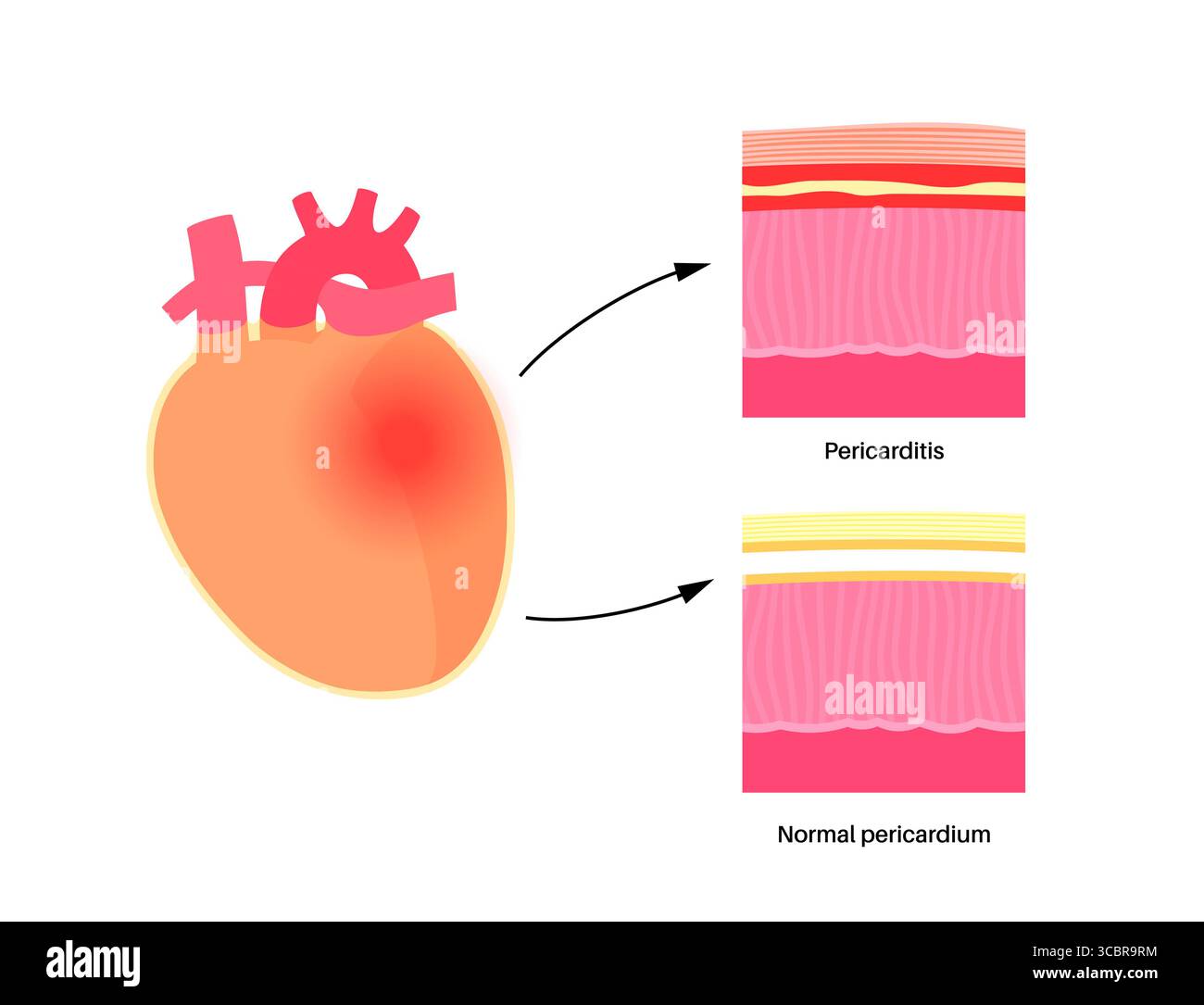 Illustration d'une péricardite cardiaque. Il s'agit d'une affection cardiaque caractérisée par une inflammation du péricarde, la structure semblable à un sac entourant le cœur. Une douleur thoracique aiguë est un symptôme courant, qui s’aggrave souvent avec des respirations profondes, couché ou toux. Elle peut être déclenchée par des infections virales ou bactériennes, des maladies auto-immunes ou des crises cardiaques. Banque D'Images Illustration d'une péricardite cardiaque. Il s'agit d'une affection cardiaque caractérisée par une inflammation du péricarde, la structure semblable à un sac entourant le cœur. Une douleur thoracique aiguë est un symptôme courant, qui s’aggrave souvent avec des respirations profondes, couché ou toux. Elle peut être déclenchée par des infections virales ou bactériennes, des maladies auto-immunes ou des crises cardiaques. Banque D'Images