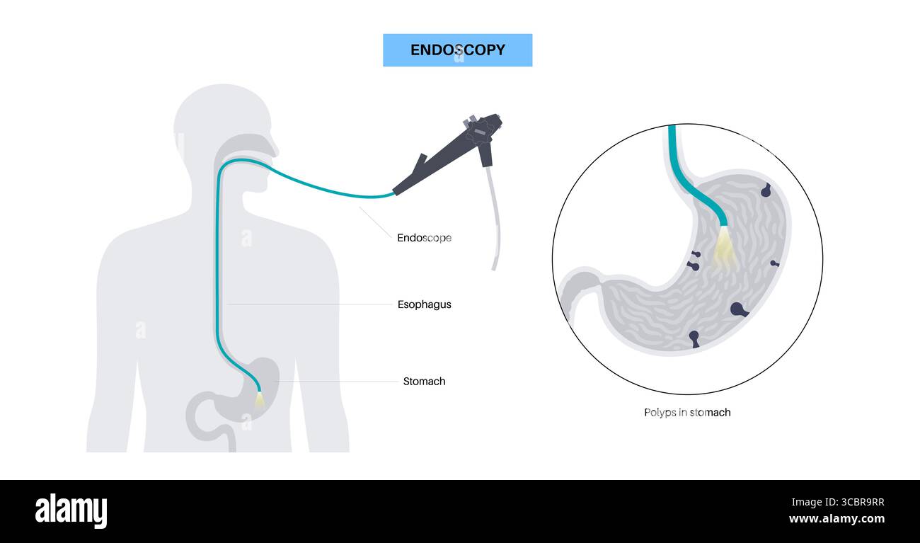 Illustration d'une gastroscopie, également connue sous le nom d'endoscopie supérieure. Il s'agit d'une procédure où un endoscope est inséré par la bouche pour examiner l'œsophage, l'estomac et le duodénum. Il aide à diagnostiquer et à traiter des affections comme les ulcères, les inflammations ou les tumeurs dans le tube digestif supérieur. Banque D'Images