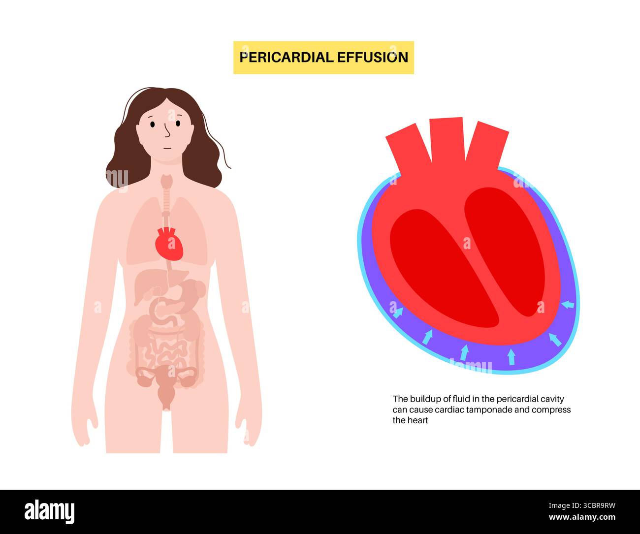 Illustration d'épanchement péricardique du coeur. Il s'agit de l'accumulation d'excès de liquide dans l'espace péricardique, le sac entourant le cœur. Cette accumulation de liquide peut exercer une pression sur le cœur, ce qui peut nuire à sa capacité à pomper efficacement le sang. Banque D'Images Illustration d'épanchement péricardique du coeur. Il s'agit de l'accumulation d'excès de liquide dans l'espace péricardique, le sac entourant le cœur. Cette accumulation de liquide peut exercer une pression sur le cœur, ce qui peut nuire à sa capacité à pomper efficacement le sang. Banque D'Images
