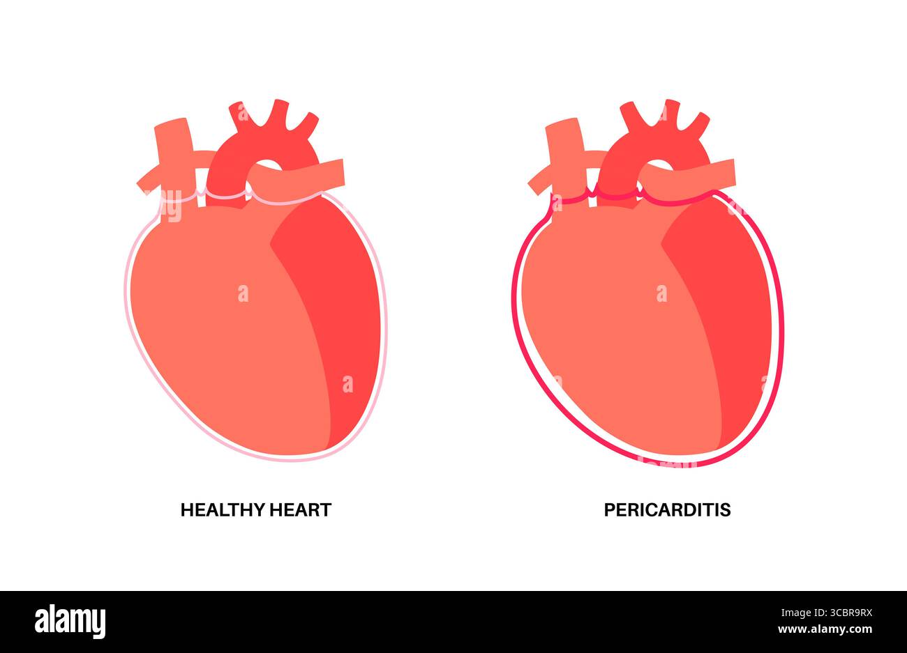 Illustration d'une péricardite cardiaque. Il s'agit d'une affection cardiaque caractérisée par une inflammation du péricarde, la structure semblable à un sac entourant le cœur. Une douleur thoracique aiguë est un symptôme courant, qui s’aggrave souvent avec des respirations profondes, couché ou toux. Elle peut être déclenchée par des infections virales ou bactériennes, des maladies auto-immunes ou des crises cardiaques. Banque D'Images Illustration d'une péricardite cardiaque. Il s'agit d'une affection cardiaque caractérisée par une inflammation du péricarde, la structure semblable à un sac entourant le cœur. Une douleur thoracique aiguë est un symptôme courant, qui s’aggrave souvent avec des respirations profondes, couché ou toux. Elle peut être déclenchée par des infections virales ou bactériennes, des maladies auto-immunes ou des crises cardiaques. Banque D'Images