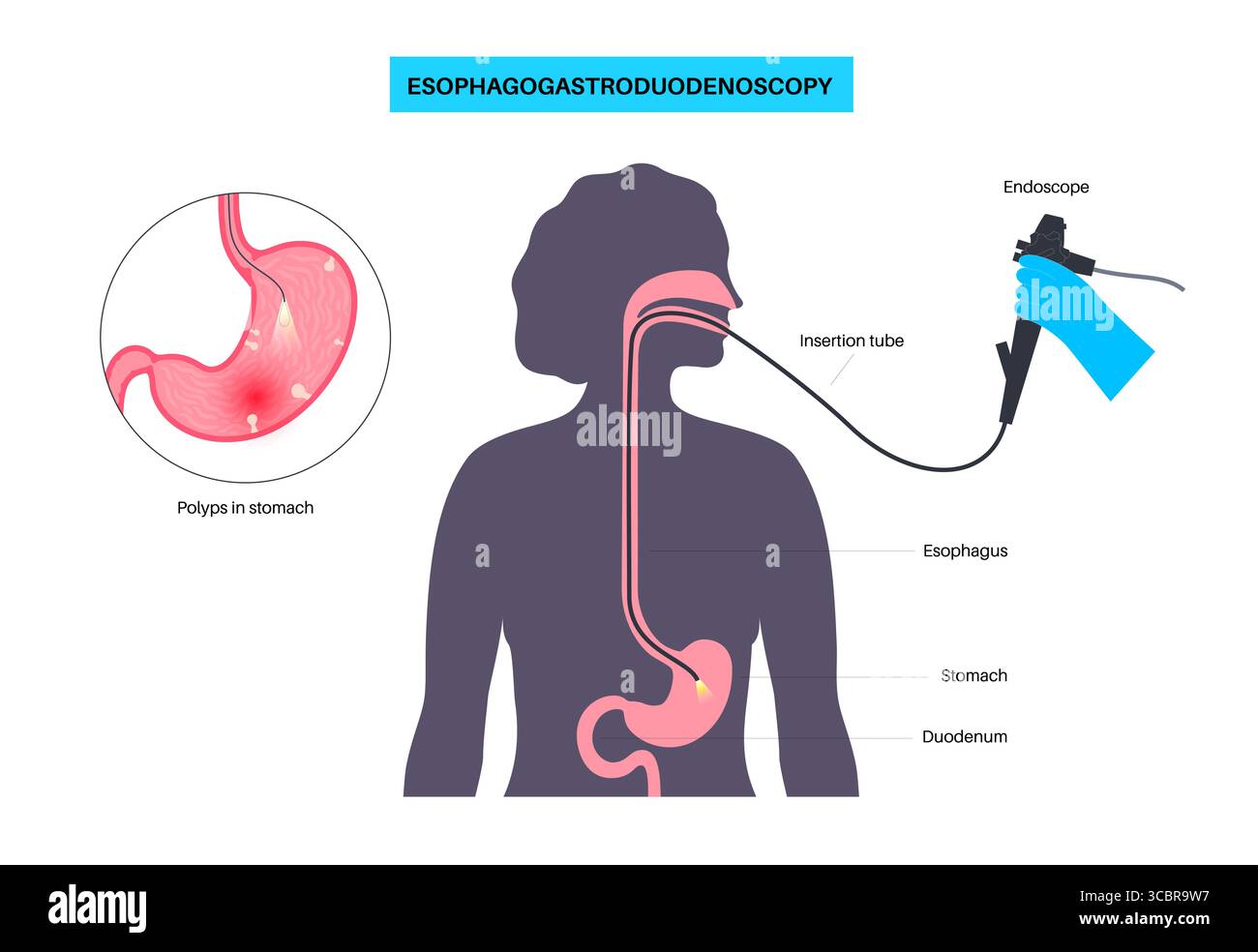 Illustration d'une gastroscopie, également connue sous le nom d'endoscopie supérieure. Il s'agit d'une procédure où un endoscope est inséré par la bouche pour examiner l'œsophage, l'estomac et le duodénum. Il aide à diagnostiquer et à traiter des affections comme les ulcères, les inflammations ou les tumeurs dans le tube digestif supérieur. Banque D'Images