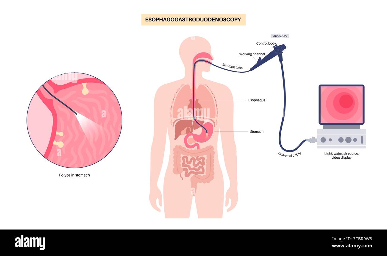 Illustration d'une gastroscopie, également connue sous le nom d'endoscopie supérieure. Il s'agit d'une procédure où un endoscope est inséré par la bouche pour examiner l'œsophage, l'estomac et le duodénum. Il aide à diagnostiquer et à traiter des affections comme les ulcères, les inflammations ou les tumeurs dans le tube digestif supérieur. Banque D'Images