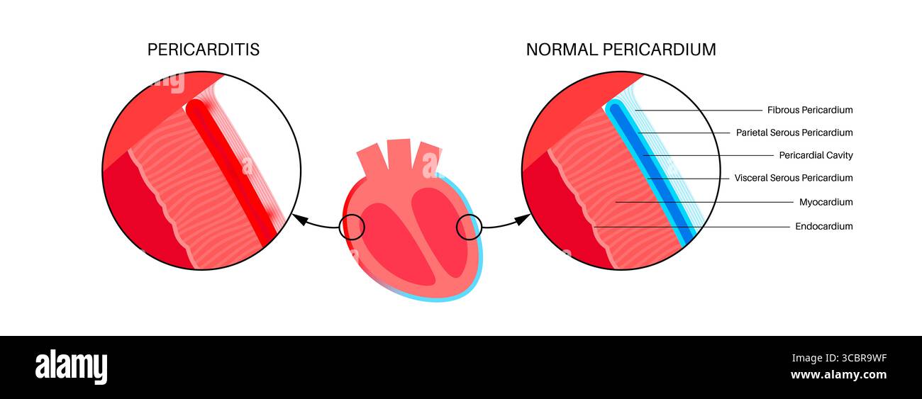 Illustration d'une péricardite cardiaque. Il s'agit d'une affection cardiaque caractérisée par une inflammation du péricarde, la structure semblable à un sac entourant le cœur. Une douleur thoracique aiguë est un symptôme courant, qui s’aggrave souvent avec des respirations profondes, couché ou toux. Elle peut être déclenchée par des infections virales ou bactériennes, des maladies auto-immunes ou des crises cardiaques. Banque D'Images Illustration d'une péricardite cardiaque. Il s'agit d'une affection cardiaque caractérisée par une inflammation du péricarde, la structure semblable à un sac entourant le cœur. Une douleur thoracique aiguë est un symptôme courant, qui s’aggrave souvent avec des respirations profondes, couché ou toux. Elle peut être déclenchée par des infections virales ou bactériennes, des maladies auto-immunes ou des crises cardiaques. Banque D'Images