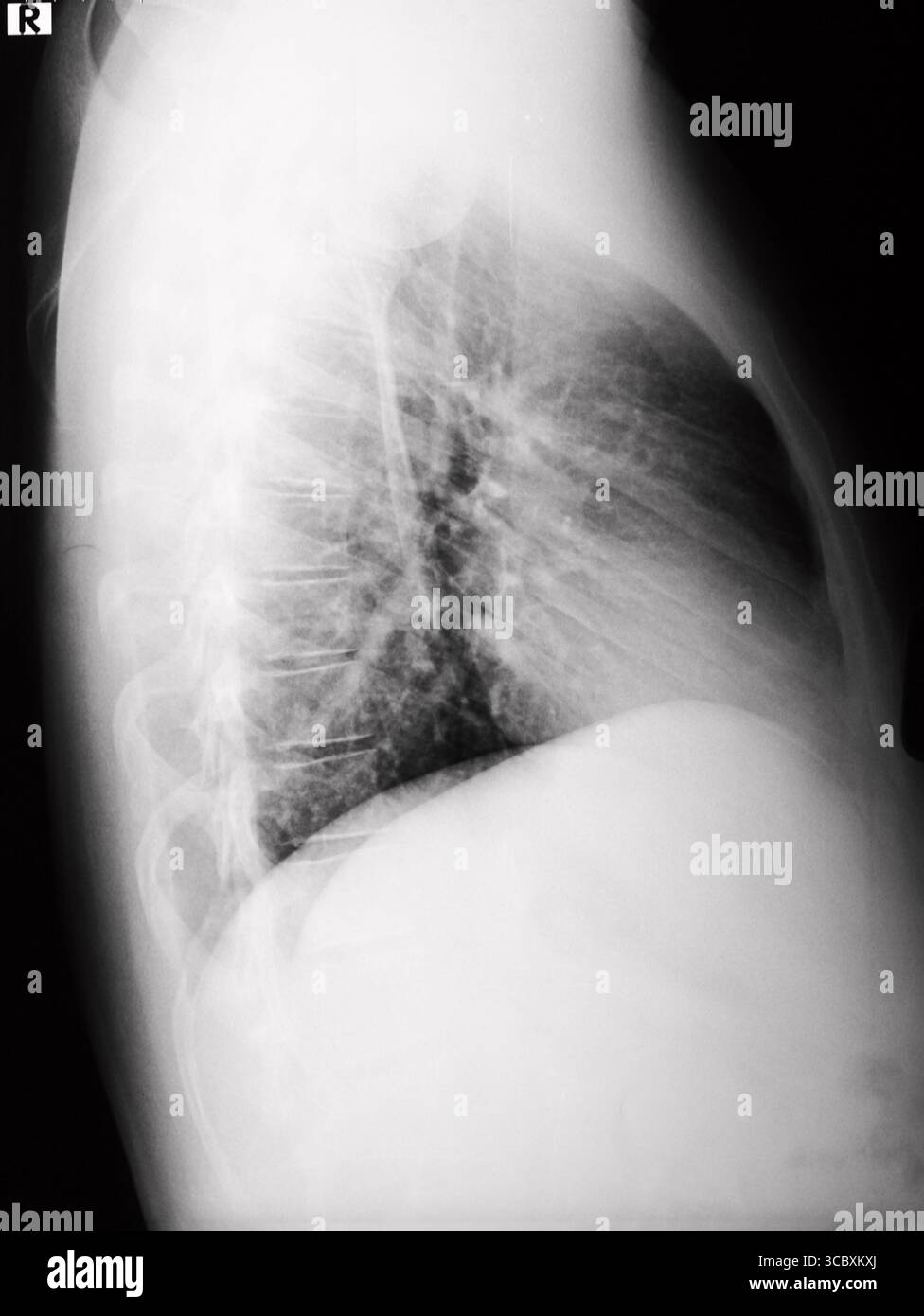 Détail d'une radiographie des poumons et du thorax masculins. Noir et blanc. Vue latérale. Banque D'Images